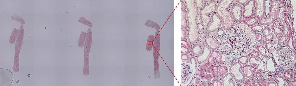 CD68(巨噬细胞)的肾小球占比分析事例